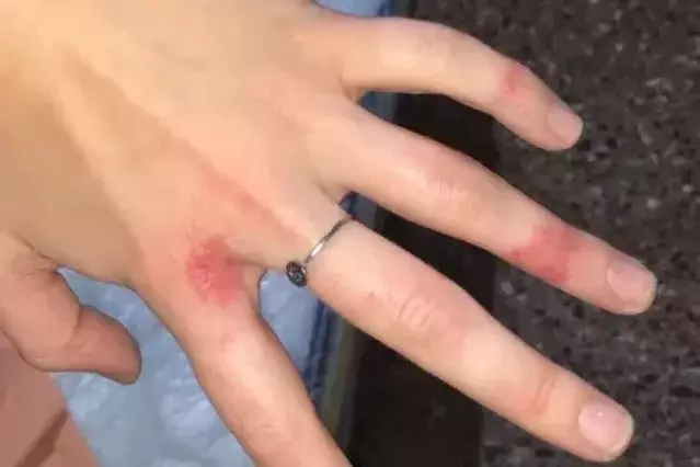 Sarna a l’alça als geriàtrics